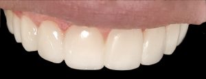 درمان کامپوزی دندان