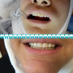 اصلاح دندان با کامپوزیت