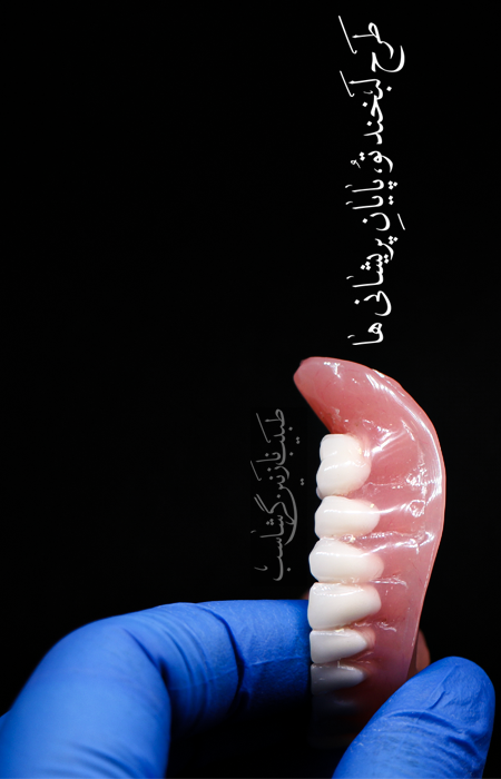 قیمت دست دندان مصنوعی کامل متحرک تهران 1401